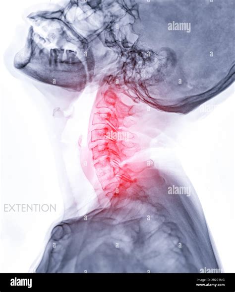 X Ray C Spine Or X Ray Image Of Cervical Spine Extension Viewfor