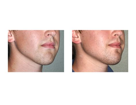 Plastic Surgery Case Study Jaw Asymmetry Correction With Chin