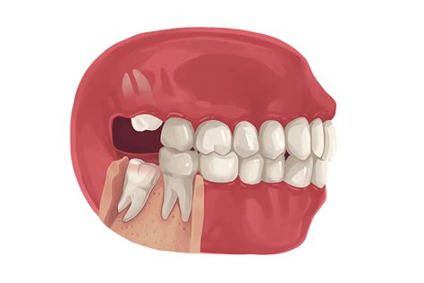 5 Signs Its Time For Your Wisdom Teeth To Be Removed Eden Prairie