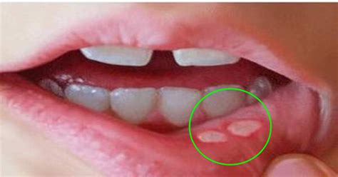 5 Natural Ways To Heal Canker Sores Quickly