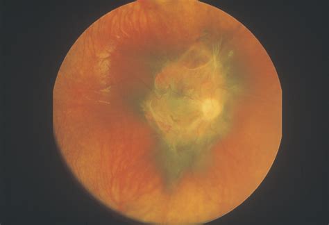 Panoramic Imaging Of The Ocular Fundus Cataract And Other Lens