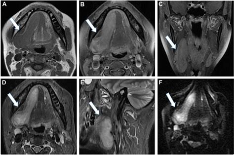Solitary ﬁbrous Tumor Of The Salivary Gland A Case Report