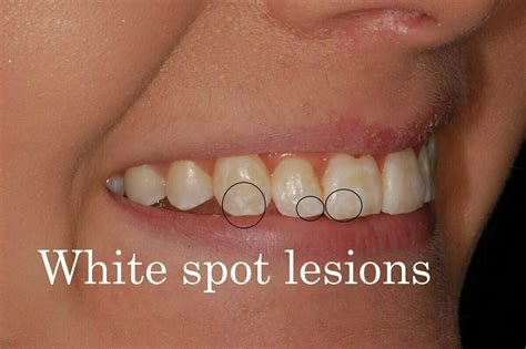 White Spot Lesions Cosa Sono Da Cosa Sono Causate E Come Trattarle