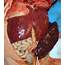 Autopsy Manual Spleen  Obstetrical Pathology