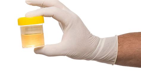 What Is Sediment In Urine Causes Symptoms And Treatment
