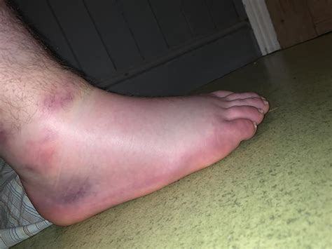 Is Bruising Like This Normal After A Sprained Ankle Or Is It Something