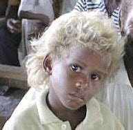 While poliosis can occur at any age, gray or white hair is uncommon in children. Black Children with Blonde Hair and Crocodile Scars | The ...