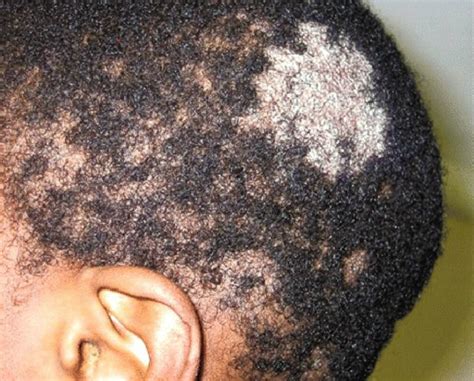 Some Scalp Disorders You Should Know About For Your Hair Health