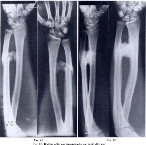 Figure 3 From Cross Union Complicating Fracture Of The Forearm