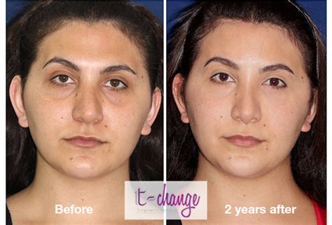 Facial Feminization Surgery Before And After FFS Pictures