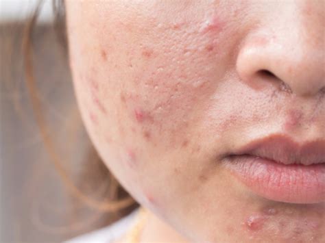 Bad Habits That Are Messing With Your Acne Business Insider