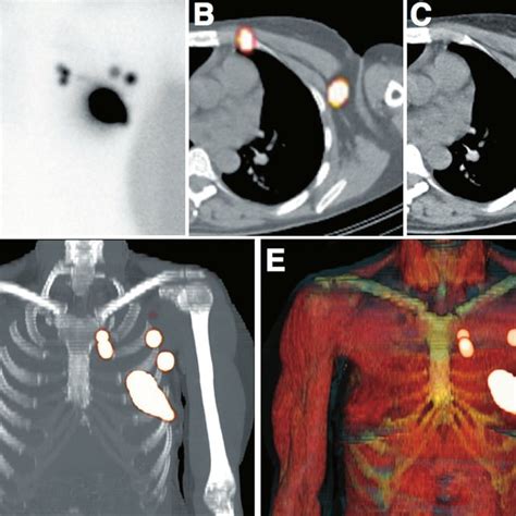 Pdf Contribution Of Spectct Imaging To Radioguided Sentinel Lymph