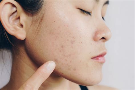 How To Get Rid Of Acne Scars And Fade Hyperpigmentation Dr Zenovia