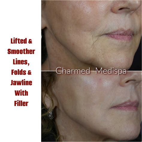 Sculpt And Define The Jawline And Improve Jowls Charmed Medispa