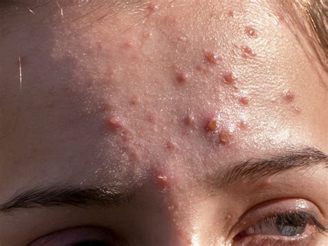 Understanding Cystic Acne A Comprehensive Guide By A Dermatologist