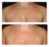 Images of Skin Discoloration After Laser Treatment