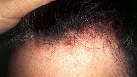 Red Itchy Bumps On Skin Causes Symptoms Pictures Trea