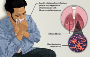 Tuberculosis (tb) is a disease caused by a type of bacteria called mycobacterium tuberculosis. Tuberculosis - Wikipedia