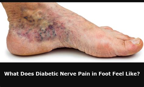 What Does Diabetic Foot Pain Feel Like —