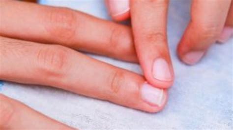 ¿cómo Prevenir Y Eliminar Padrastros De Las Uñas Su Médico