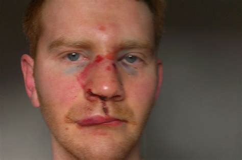 Man Left Battered And Bruised After Being Punched In Face Surrey Live