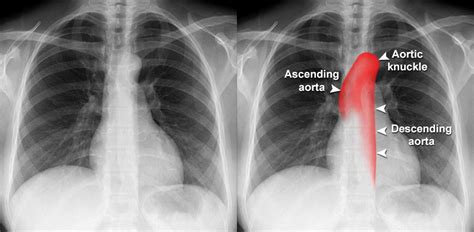 Chest X Ray Quality Normal Chest X Ray Aortic Unfolding