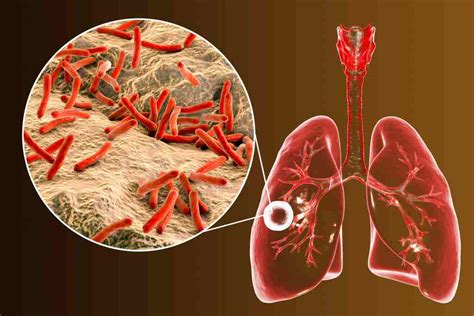 Tuberkulosis Tbc Gejala Penyebab Diagnosis And Pengobatan