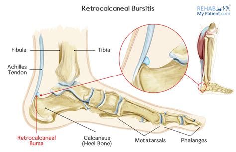 Achilles Bursitis Retrocalcaneal Bursitis Symptoms Causes Treatment