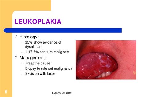 Ppt Premalignant Conditions Of The Oral Cavity Powerpoint