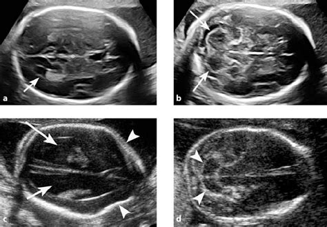1 A D Axial Views Of The Fetal Head Used For Mid Trimester Ultrasound