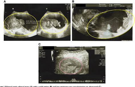 Figure 1 From Identifying Features Of Primary Fallopian Tube Carcinoma