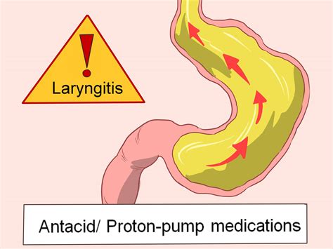 How To Treat Laryngitis 10 Steps
