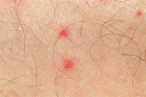 Petechiae Symptoms Causes Treatment Prevention