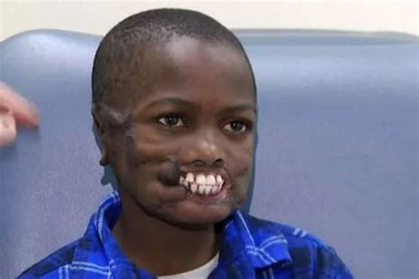 Eight Year Old Boy Who Was Mauled By Chimps Gets New Pair Of Lips In