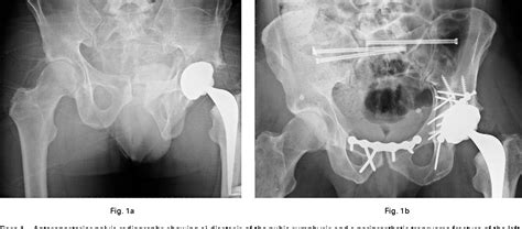 Figure 1 From Survival Of Ceramic Bearings In Total Hip Replacement