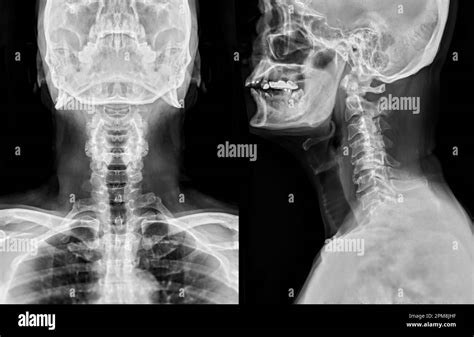 X Ray C Spine Or X Ray Image Of Cervical Spine Ap And Lateral View For