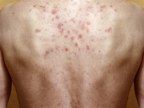 Dermatite Sulla Pelle Del Manichino Reazione Allergica Eruzione Allergica Della Pelle Del