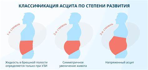 Цирроз печени асцит лечение диета Proč může být ascites? Proč může být ascites? Цирроз печени асцит лечение диета