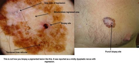 Dermoscopy Made Simple Melanoma In Situ Mainly