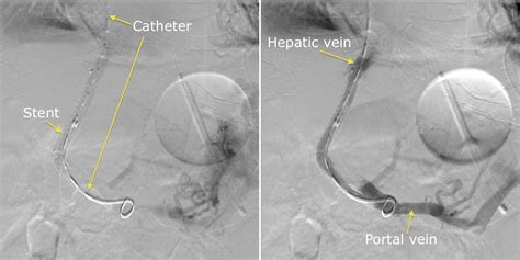 Tips Radiology At St Vincents University Hospital