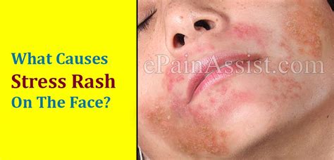 Itchy Rash From Stress