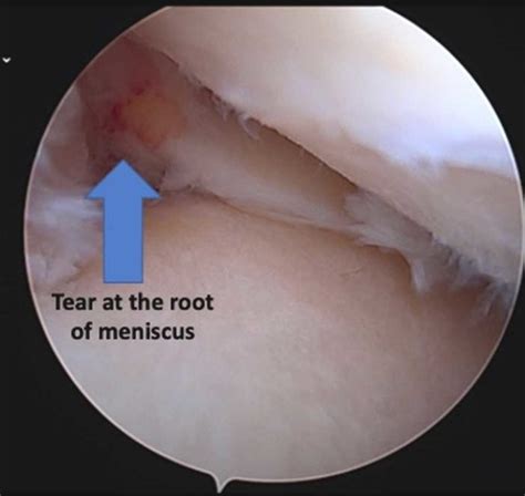Meniscus Root Tear Repair Orthopedic Knee Surgeon Manhattan New York City NY