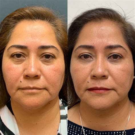 The Magic Of Prp Before And After Beauty Boost Med Spa