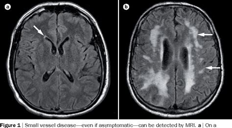 Small Vessel Disease Brain Mri Slide Share