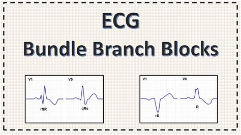 Bundle Branch Block Ecg Right Bundle Branch Block Left Bundle