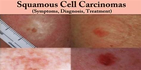 Squamous Cell Carcinomas Symptoms Diagnosis Treatment Msrblog