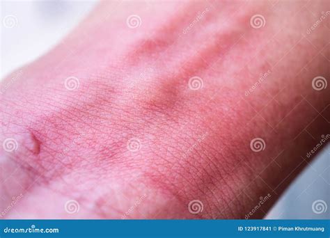 Skin Allergy With Rash After Mosquito Bite Stock Image Image Of Itchy