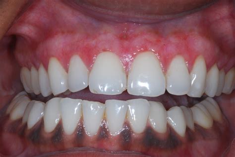 Blog Dental Implants Chrysalis Dental Centres Canada