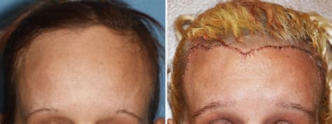 Plastic Surgery Case Study Total Female Forehead Reduction Explore