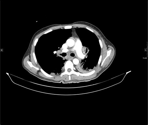 Figure 2 Ct Chest 2 A Rare Case Of Community Acquired Cavitary Lung